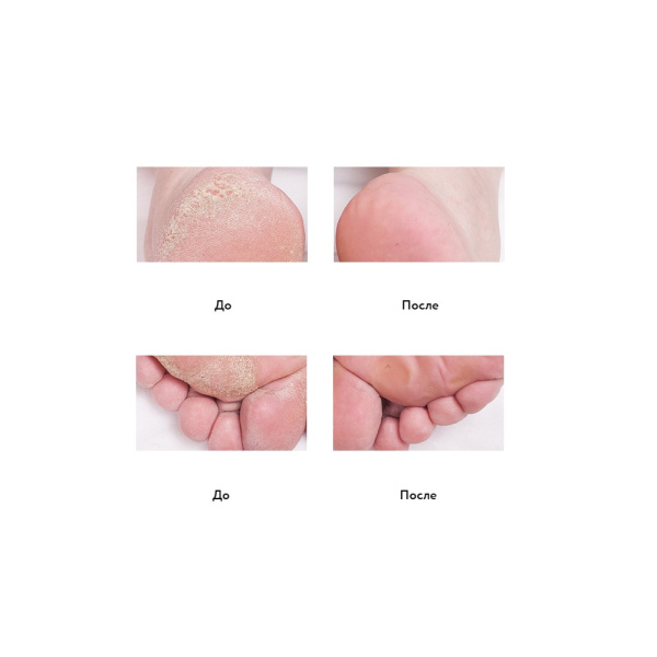 средство от натоптышей